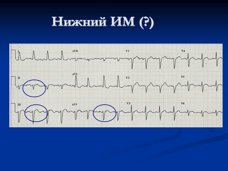 Нижний ИМ (?)